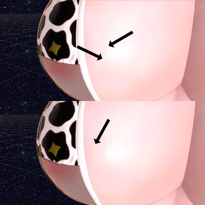 Areola Fix